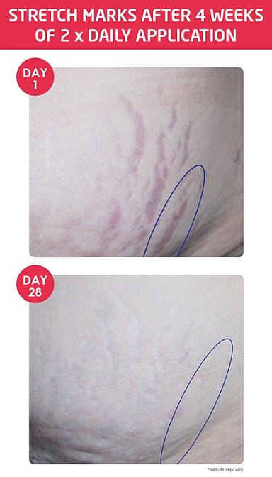 Stretch Mark Body Butter