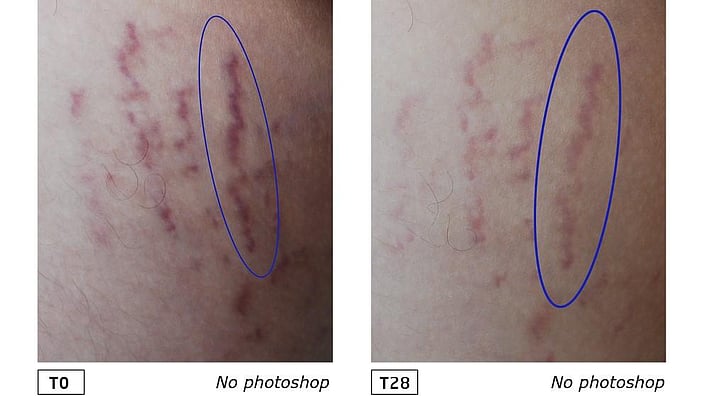 Stretch marks before and after
