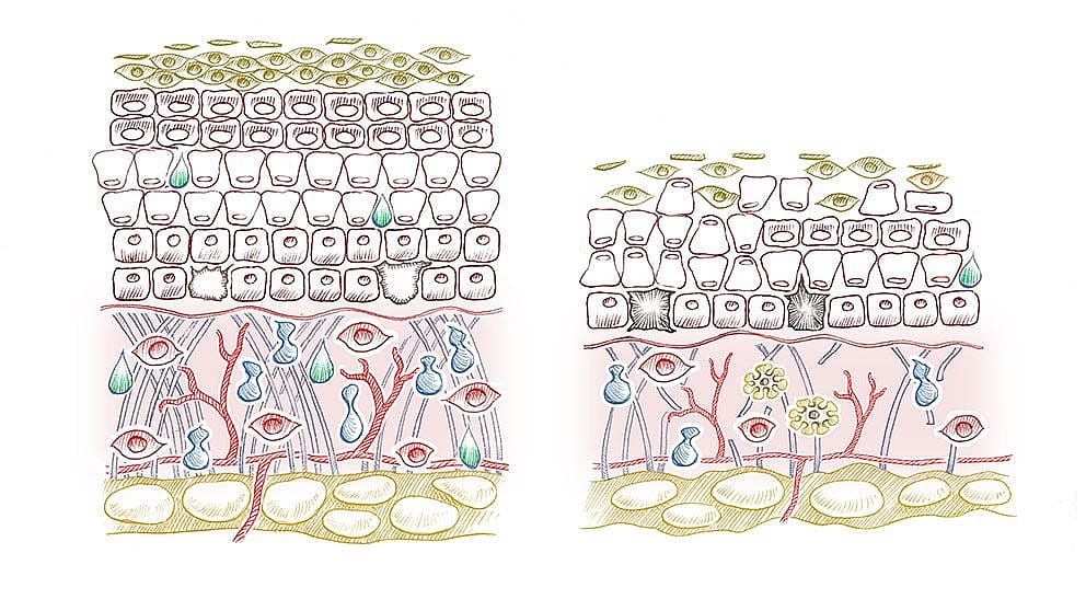 Comparison of young, healthy skin versus aged skin.